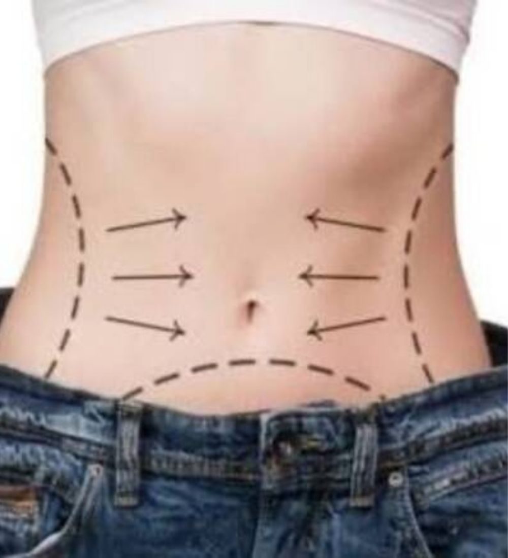 Cirurgia Pós-Bariátrica
