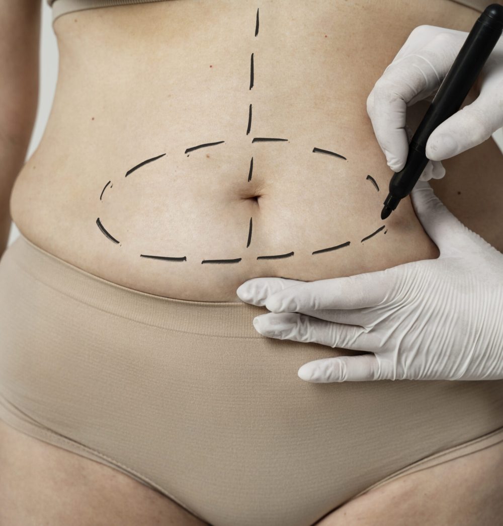 mulher-de-vista-frontal-com-tracos-de-marcador-na-barriga